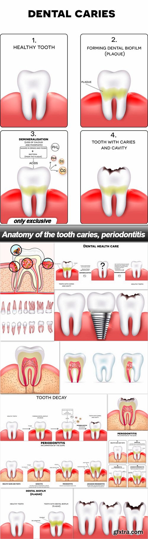 Anatomy of the tooth caries, periodontitis - 13 EPS