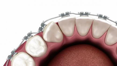 Videohive - Cuspid correction with braces. Medically accurate dental 3D illustration - 43253871