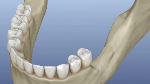 Videohive - Implantation with mini implants in to recessed jaw bone: Medically accurate 3D animation - 43220629