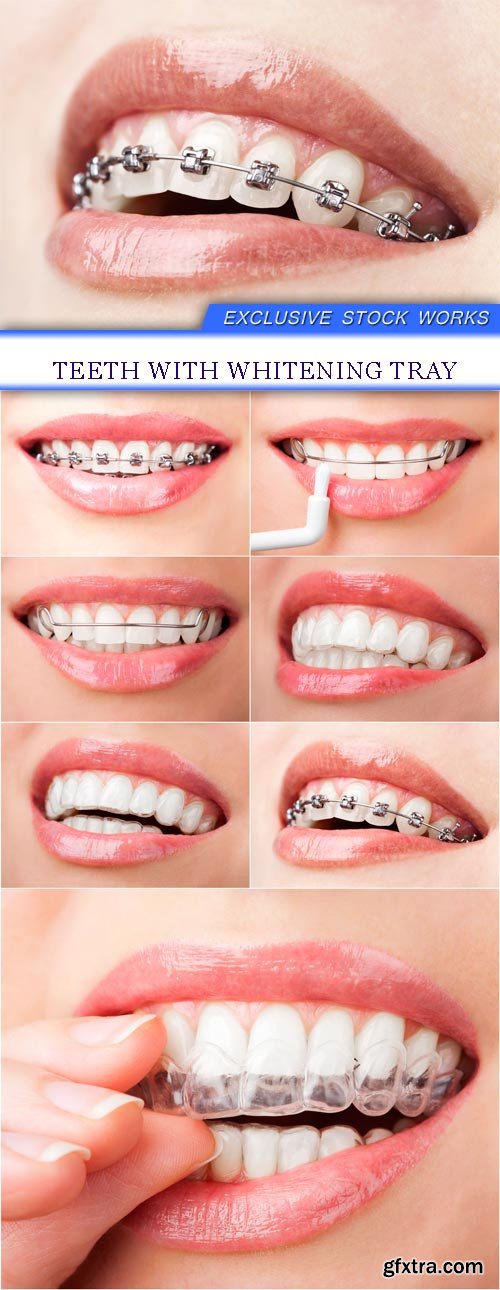 Teeth with Whitening Tray 7xJPG