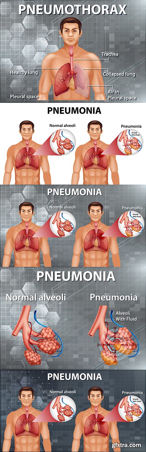 Human anatomy showing pneumonia diagram illustration