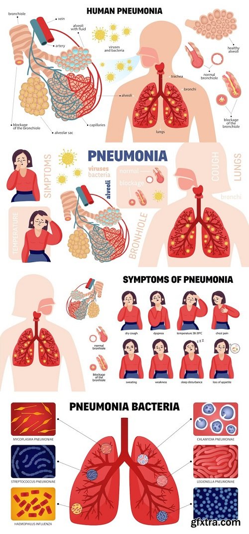 Human pneumonia set of infographic elements