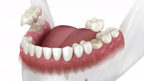 Videohive - Installation of dental bridge and single crown - 43254790