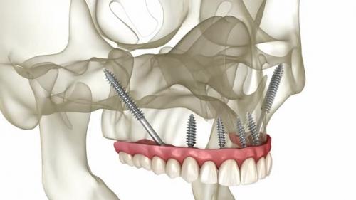 Videohive - Maxillary and Mandibular prosthesis supported by zygomatic implants - 43253889