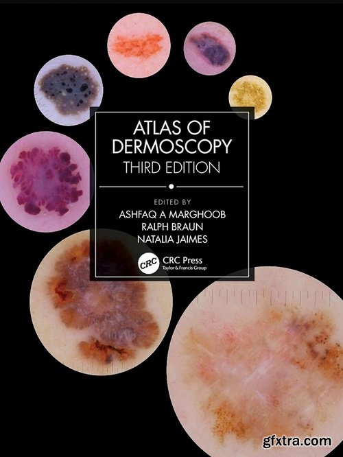 Atlas of Dermoscopy, 3rd Edition